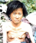 Mass Starvation in North Korea
